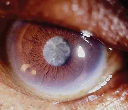 Cataract Vision Care