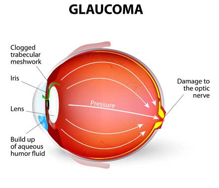 Glaucoma Vision Care